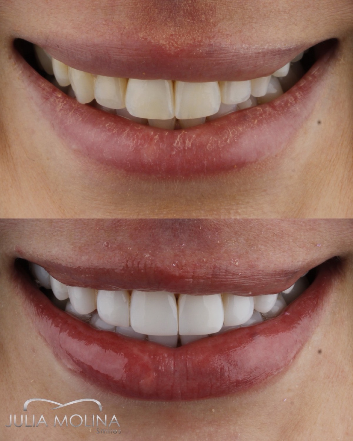 Porcelain veneers before after Dr. Julia Molina Colombia