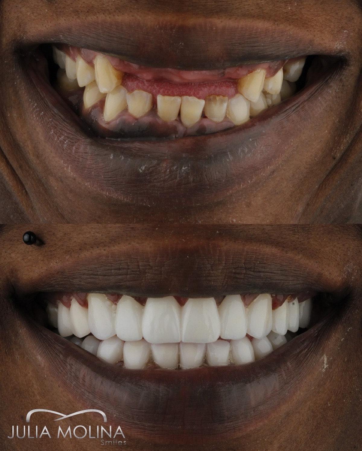 Complete dental transformation before after Colombia