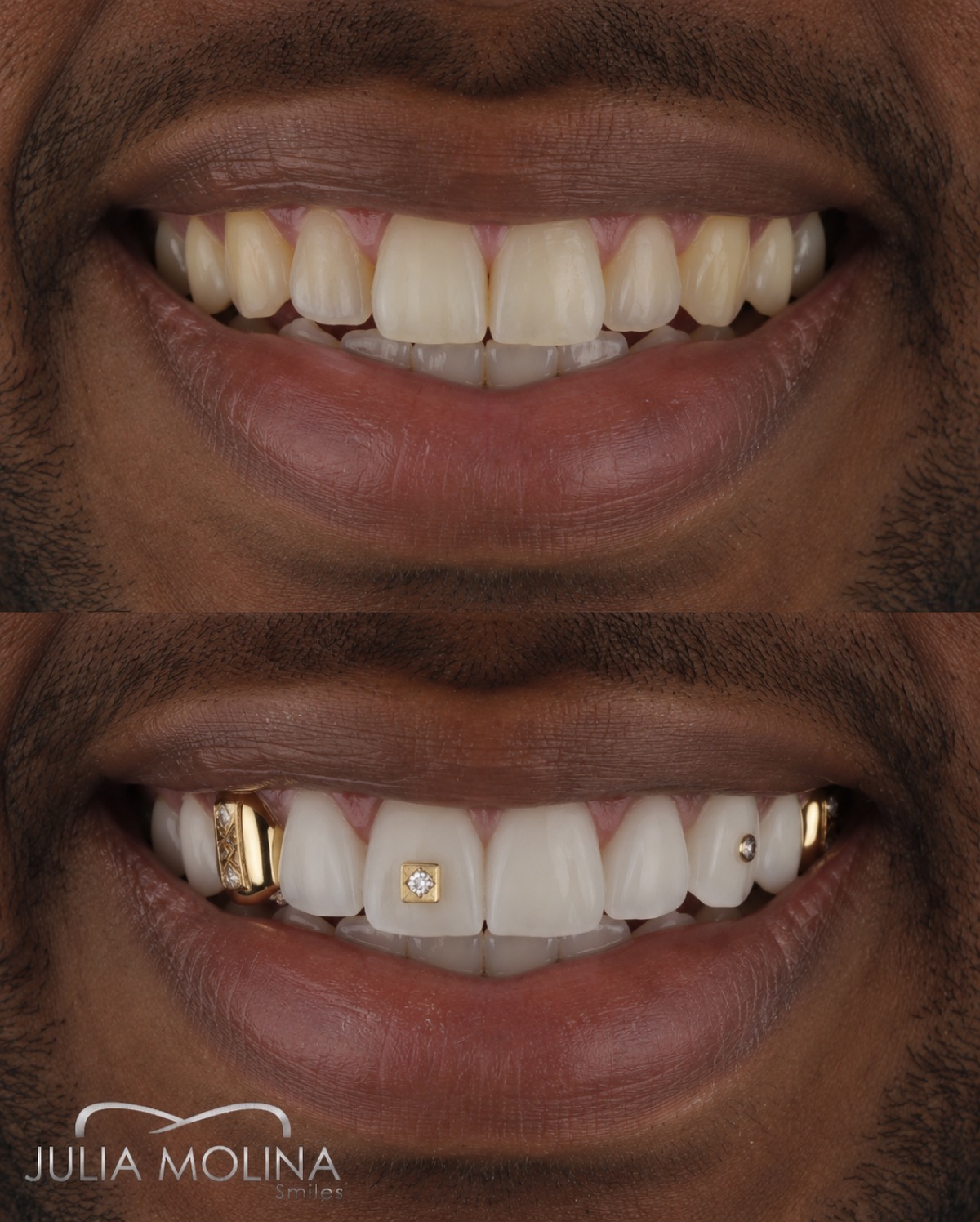 Gold diamond teeth before after Dr. Julia Molina Colombia