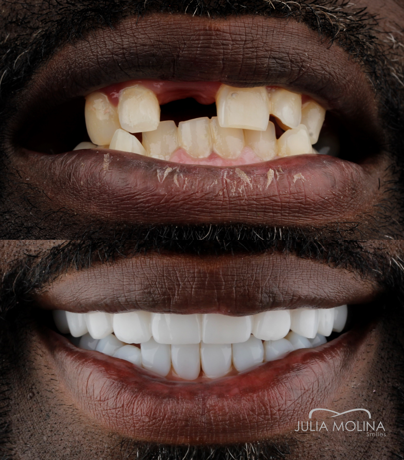 Antes y después tratamiento dental Dr Julia Molina