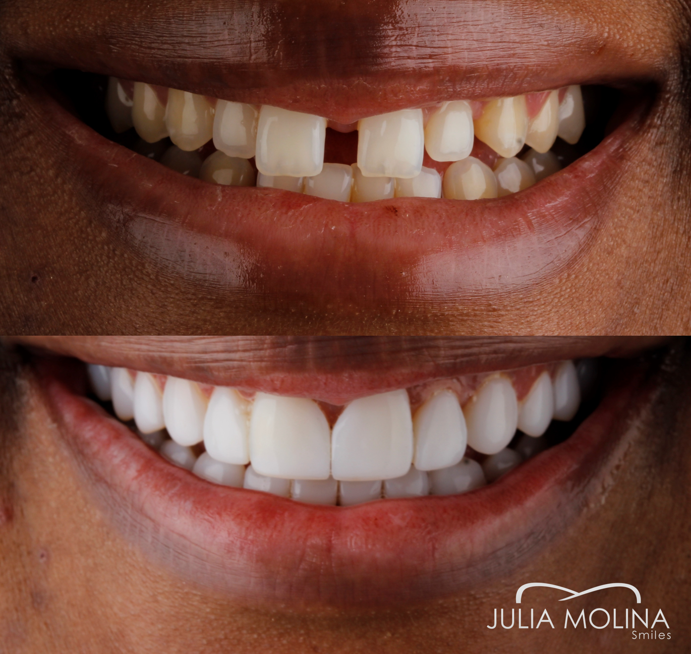 Antes y después tratamiento dental Dr Julia Molina