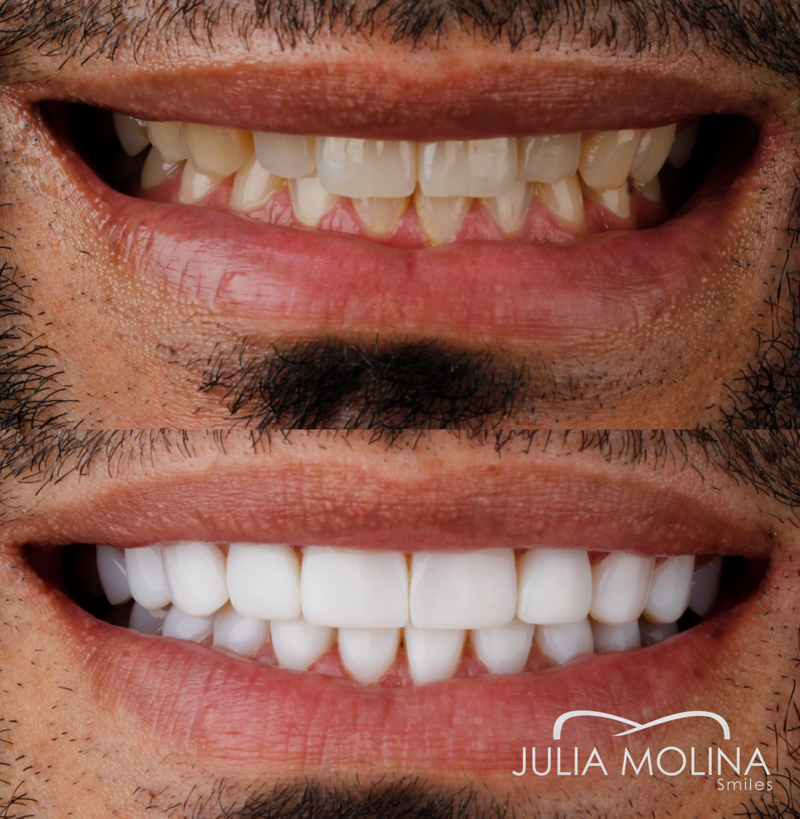 Antes y después tratamiento dental Dr Julia Molina