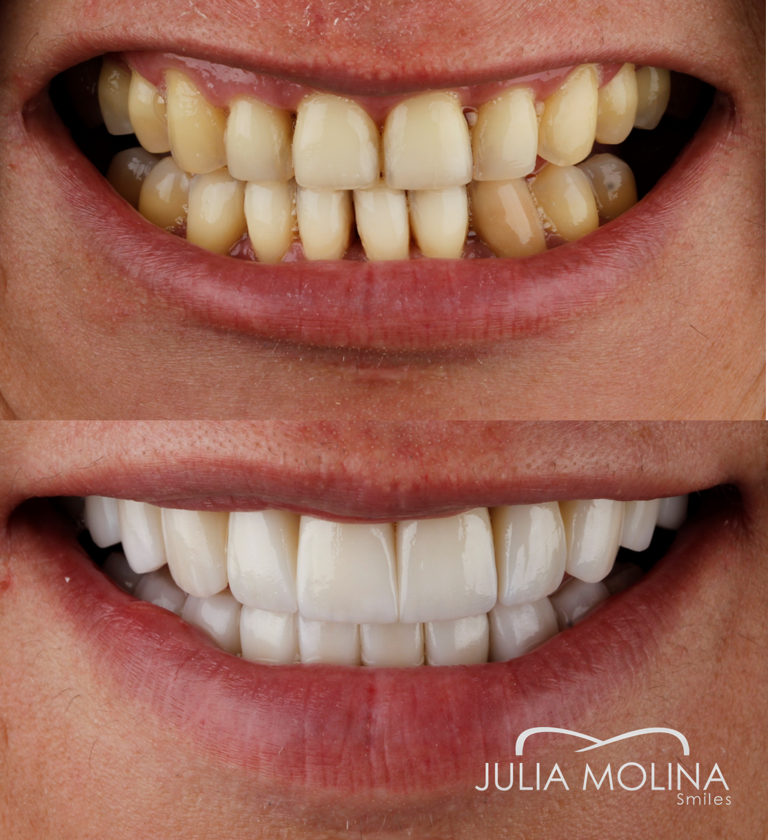 Antes y después tratamiento dental Dr Julia Molina