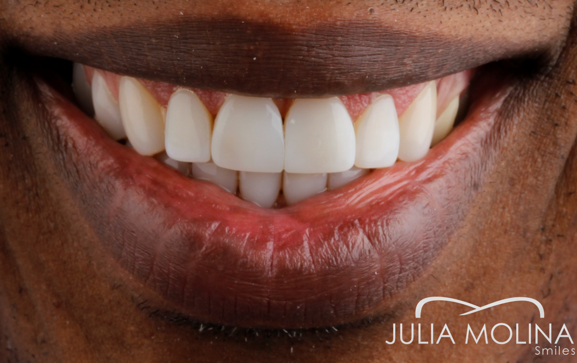 Antes y después tratamiento dental Dr Julia Molina