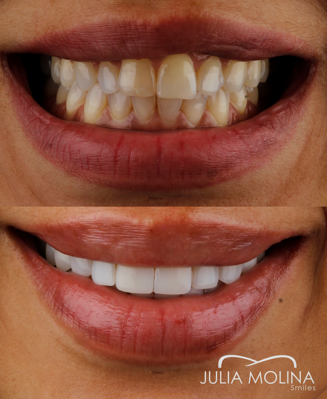 Antes y después tratamiento dental Dr Julia Molina