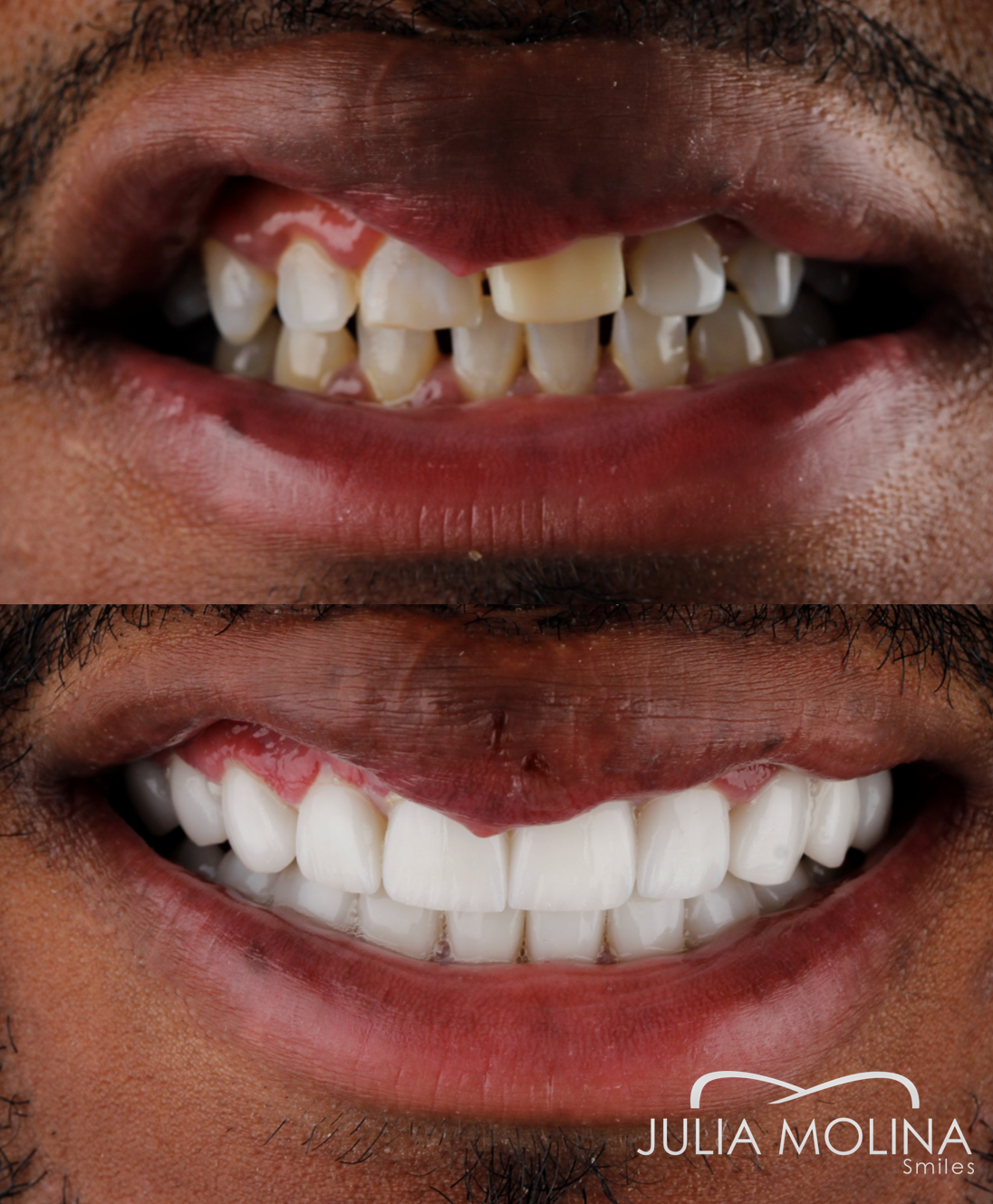 Antes y después tratamiento dental Dr Julia Molina