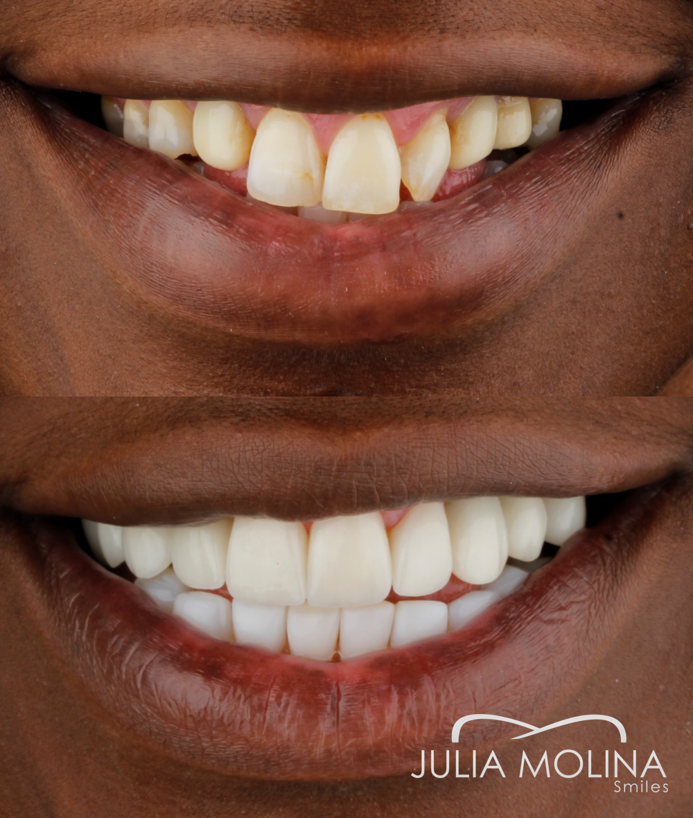 Antes y después tratamiento dental Dr Julia Molina