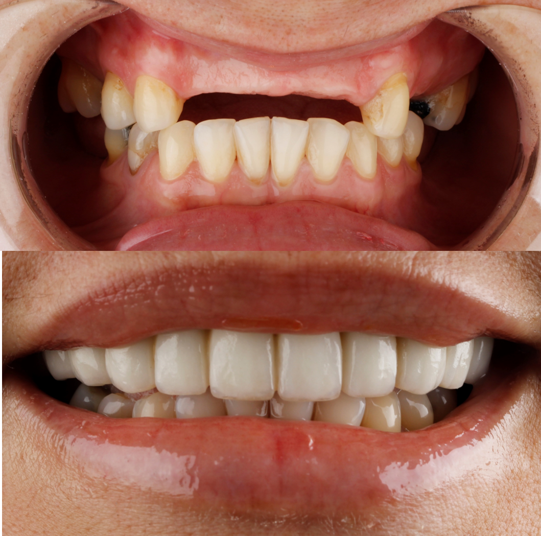Antes y después tratamiento dental Dr Julia Molina