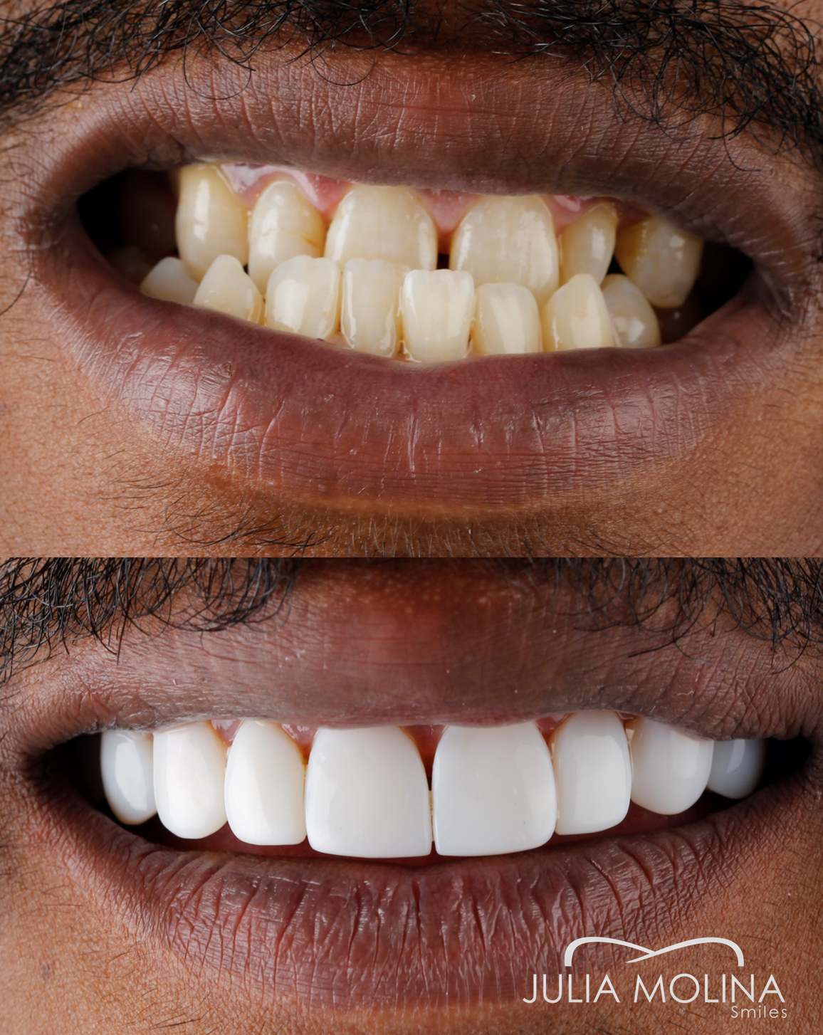 Antes y después tratamiento dental Dr Julia Molina