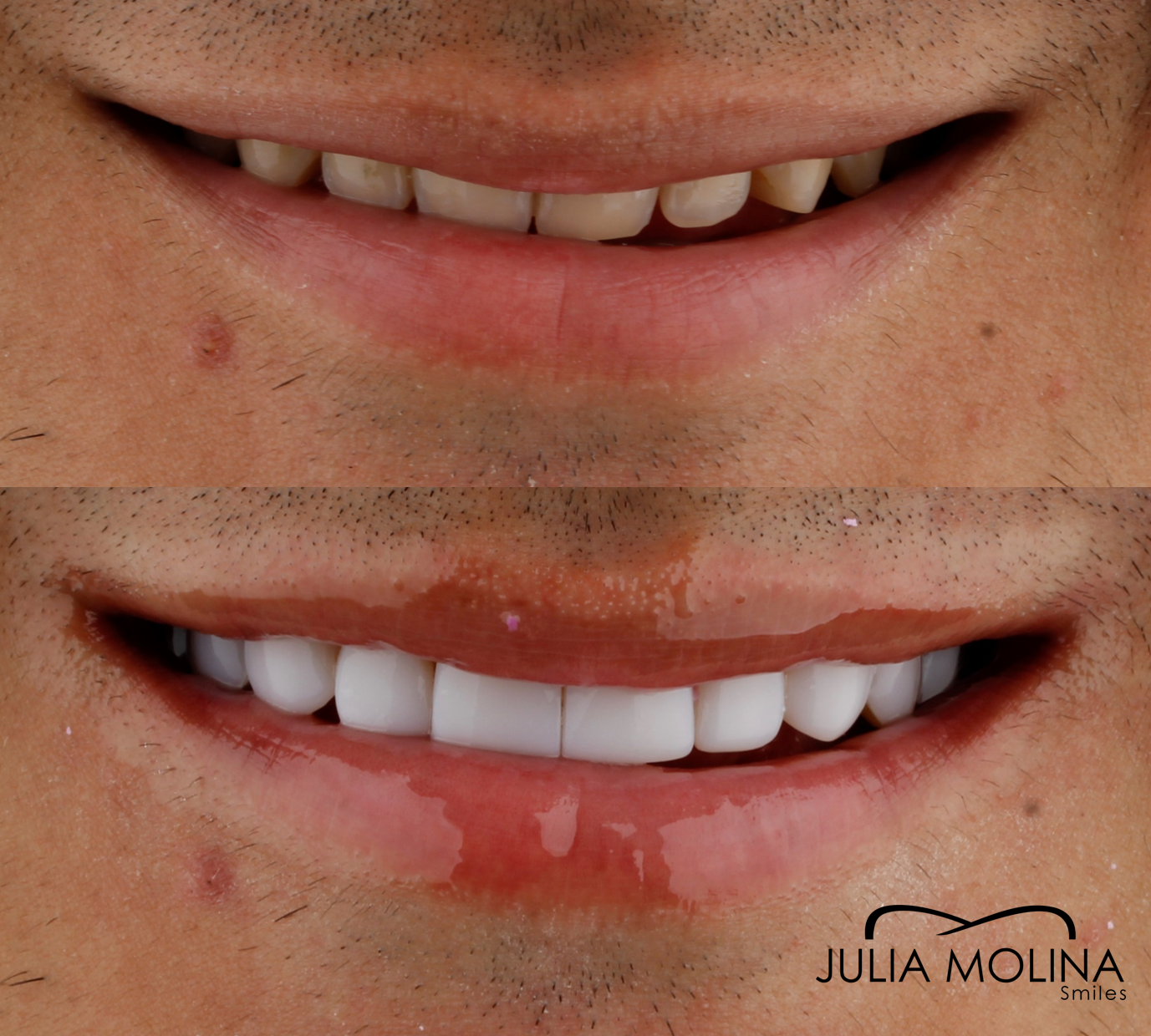 Antes y después tratamiento dental Dr Julia Molina