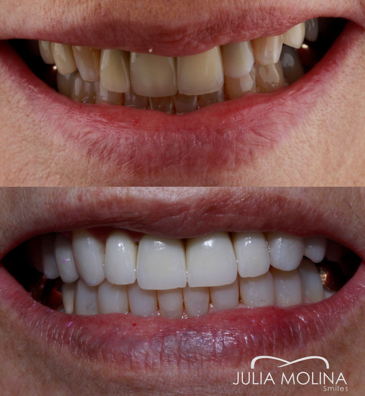 Antes y después tratamiento dental Dr Julia Molina