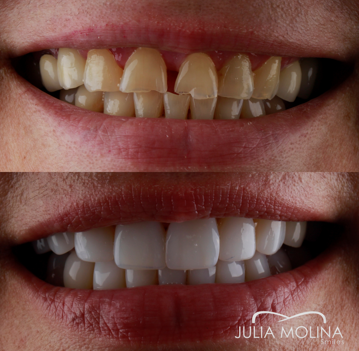 Antes y después tratamiento dental Dr Julia Molina