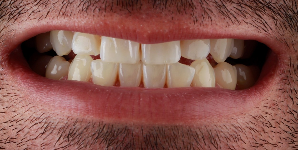 Antes y después tratamiento dental Dr Julia Molina