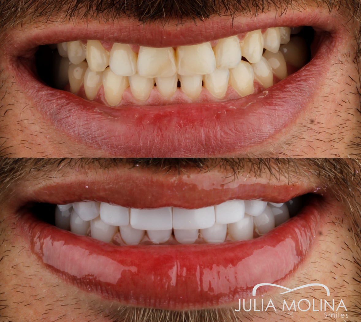 Antes y después tratamiento dental Dr Julia Molina