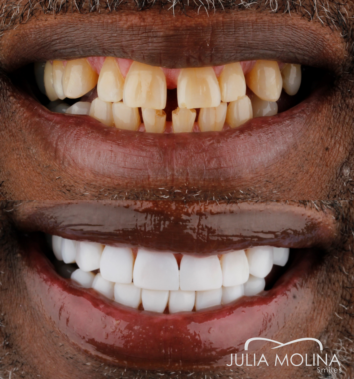 Antes y después tratamiento dental Dr Julia Molina