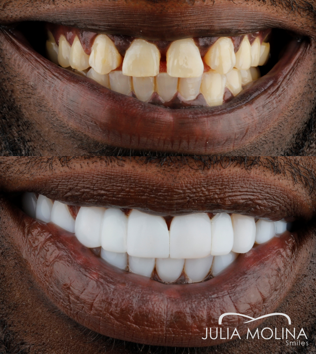 Antes y después tratamiento dental Dr Julia Molina