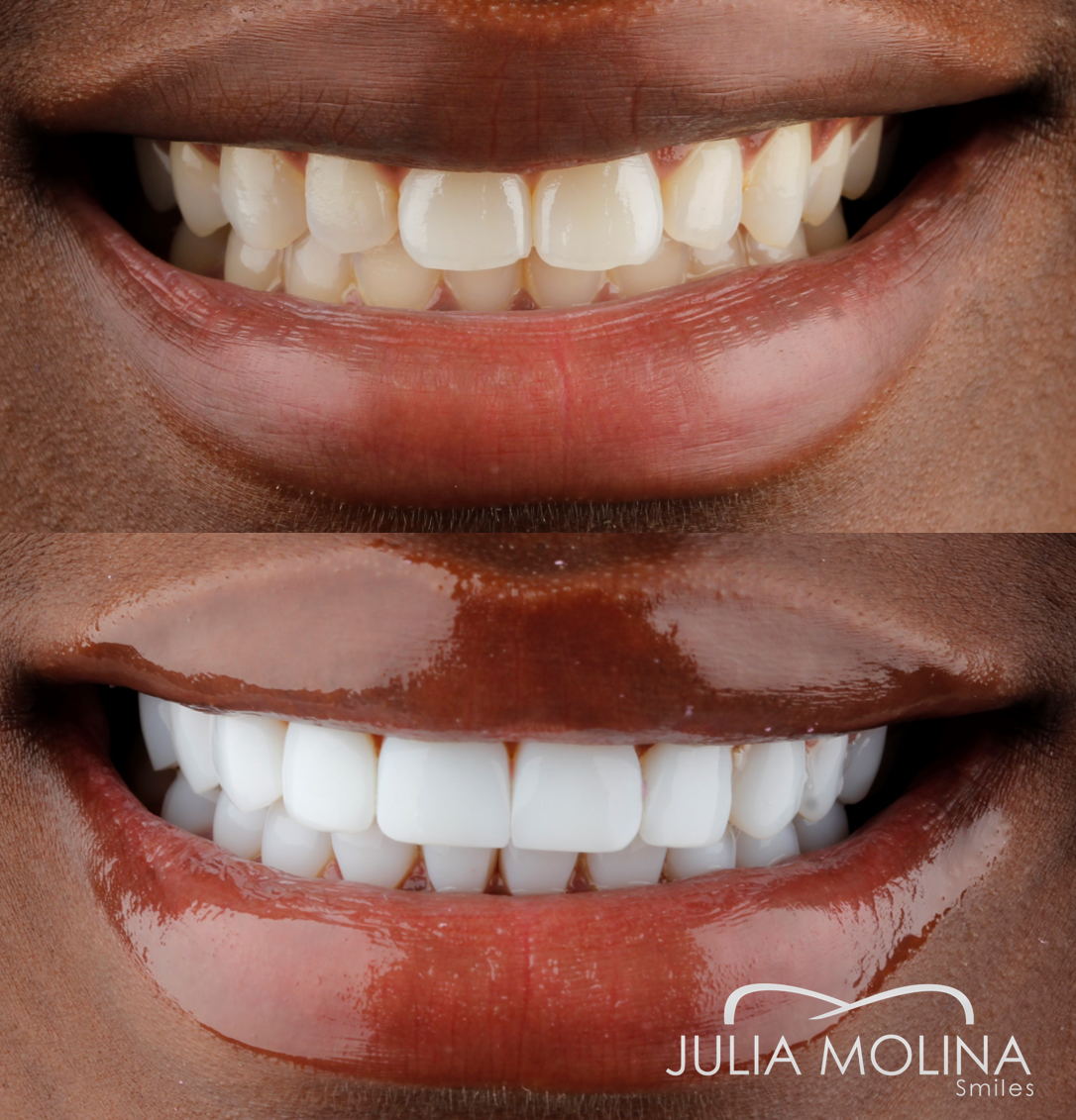 Antes y después tratamiento dental Dr Julia Molina