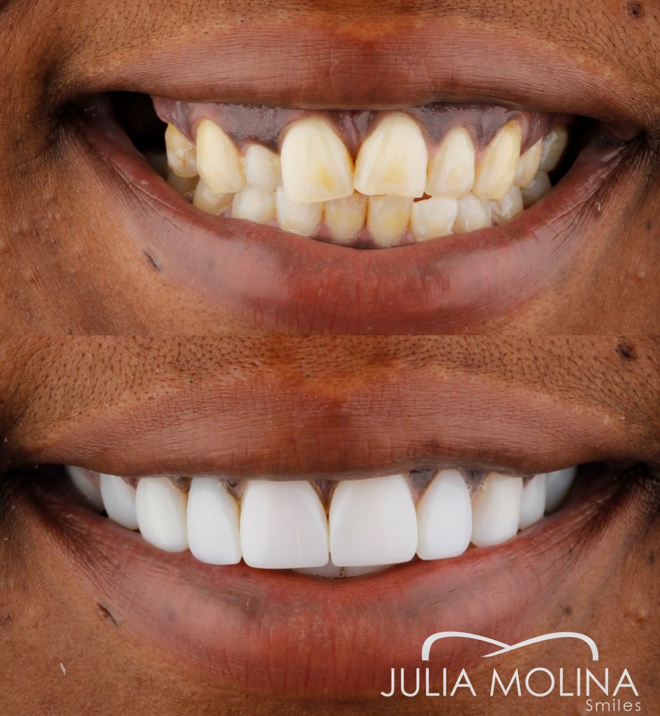 Antes y después tratamiento dental Dr Julia Molina
