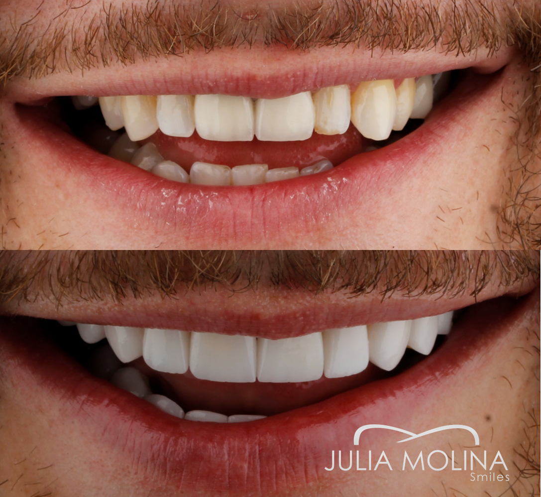 Antes y después tratamiento dental Dr Julia Molina