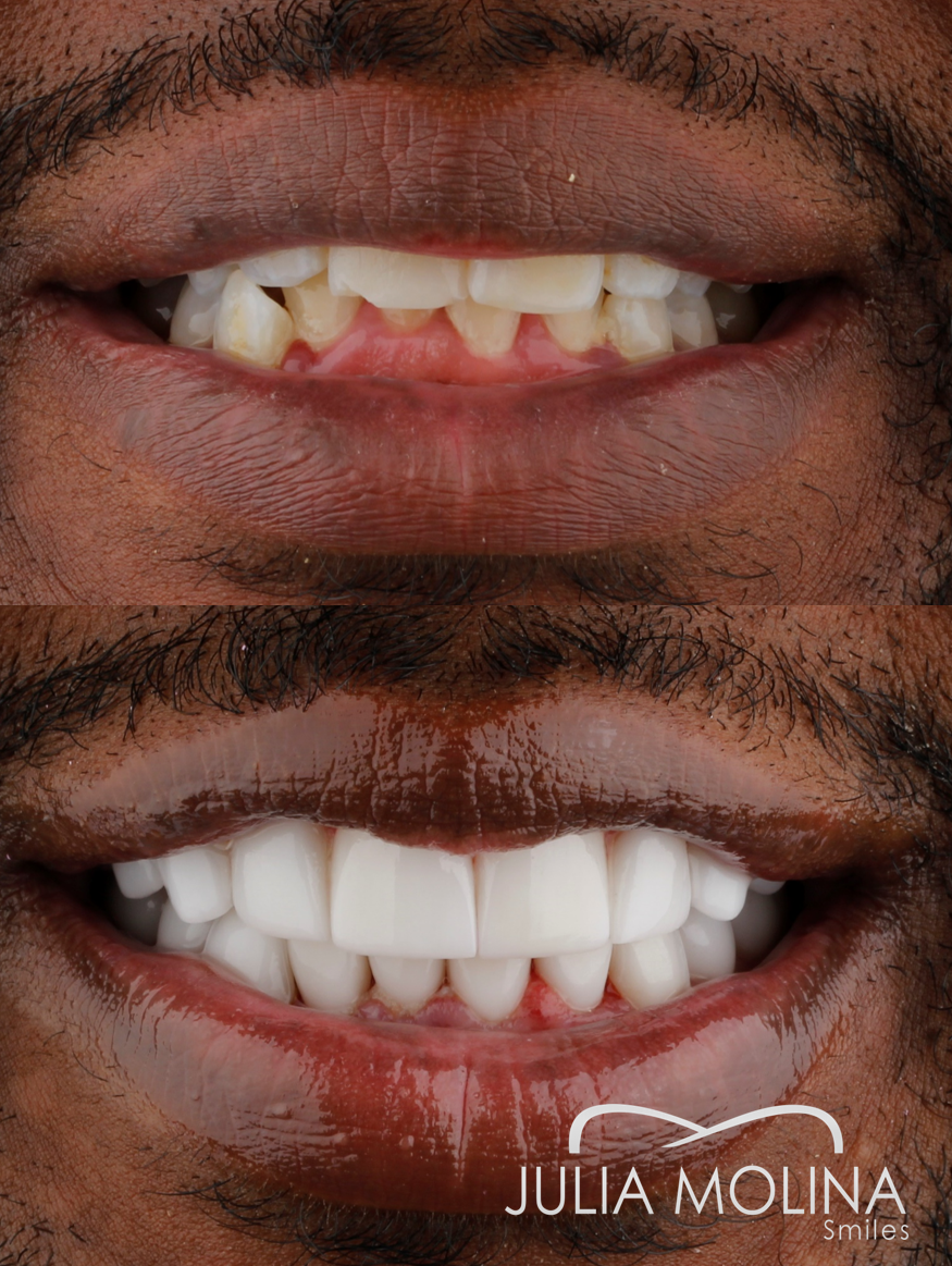 Antes y después tratamiento dental Dr Julia Molina