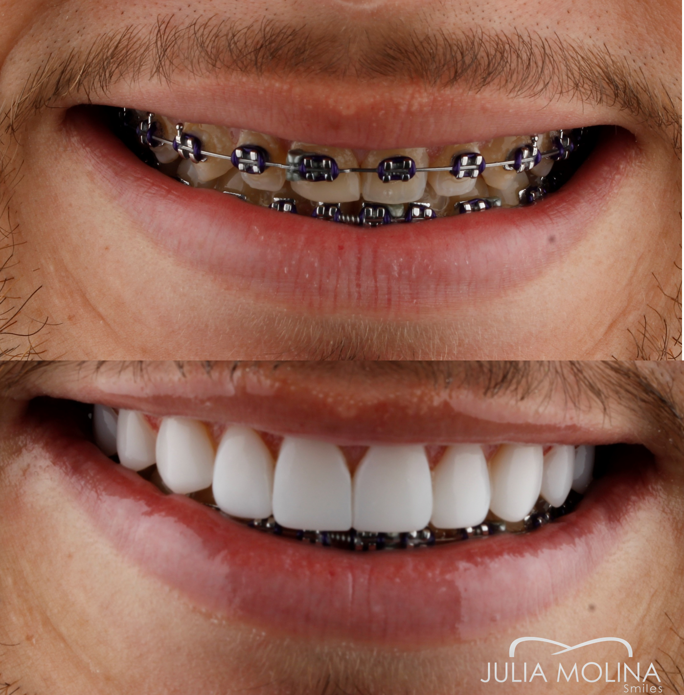 Antes y después tratamiento dental Dr Julia Molina