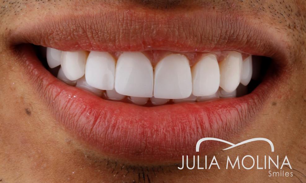 Antes y después tratamiento dental Dr Julia Molina