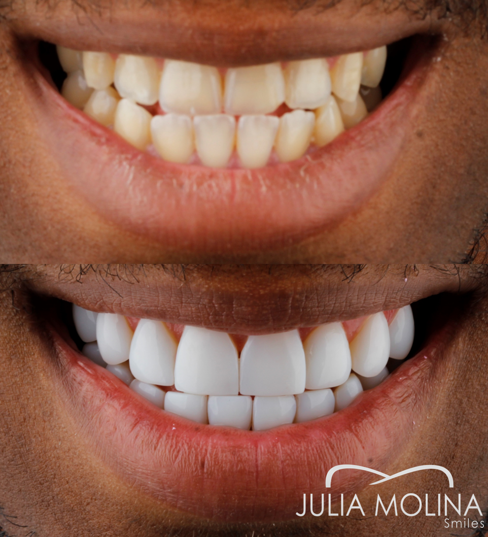 Antes y después tratamiento dental Dr Julia Molina