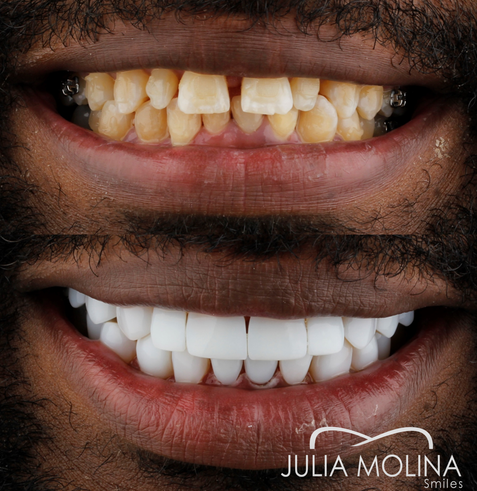 Antes y después tratamiento dental Dr Julia Molina