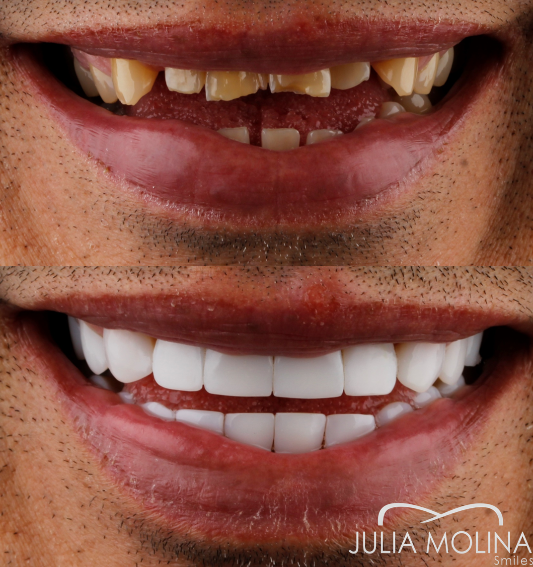 Antes y después tratamiento dental Dr Julia Molina