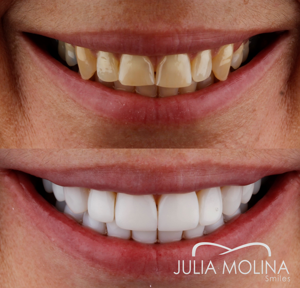 Antes y después tratamiento dental Dr Julia Molina