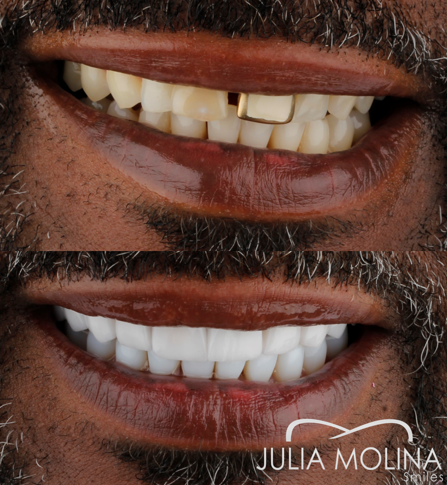 Antes y después tratamiento dental Dr Julia Molina