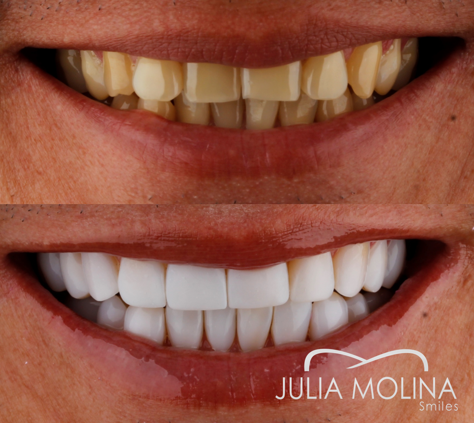 Antes y después tratamiento dental Dr Julia Molina