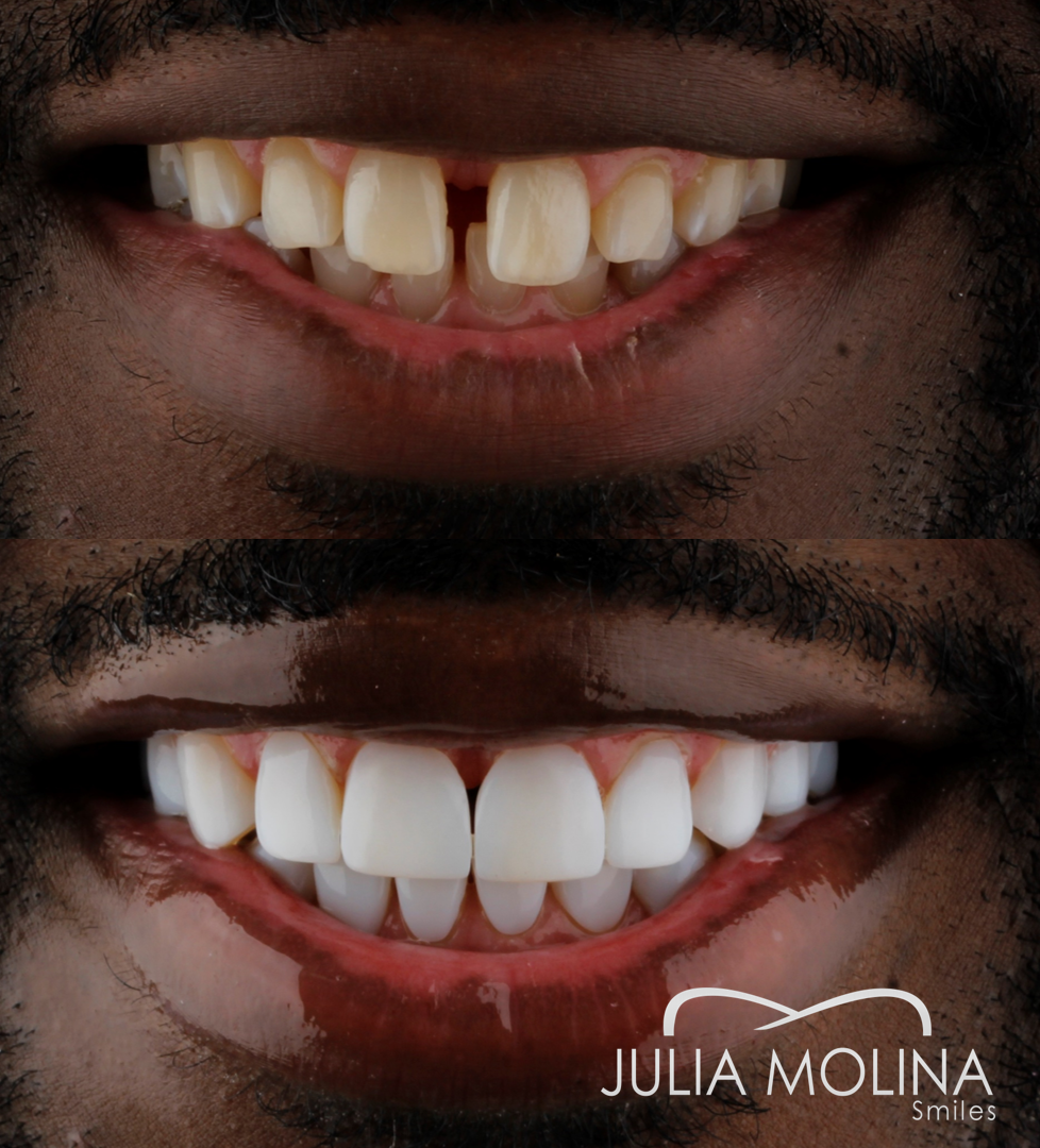 Antes y después tratamiento dental Dr Julia Molina