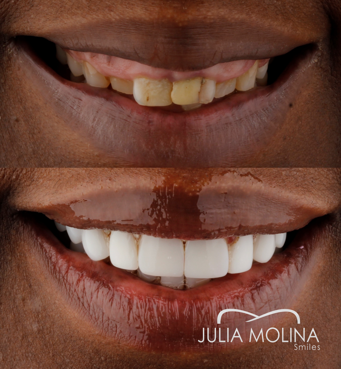 Antes y después tratamiento dental Dr Julia Molina