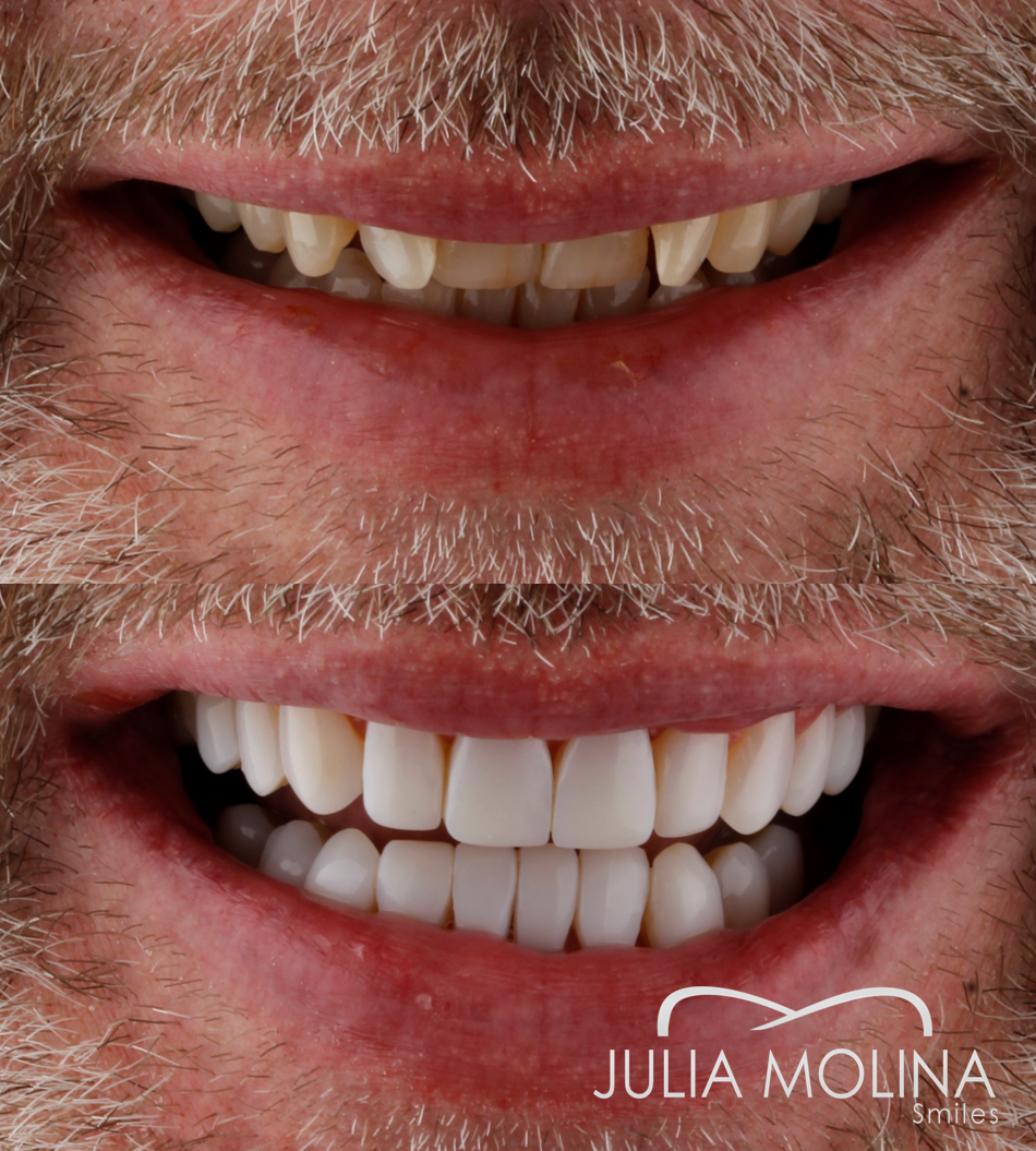 Antes y después tratamiento dental Dr Julia Molina