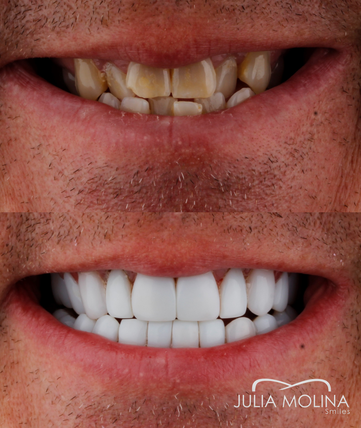 Antes y después tratamiento dental Dr Julia Molina