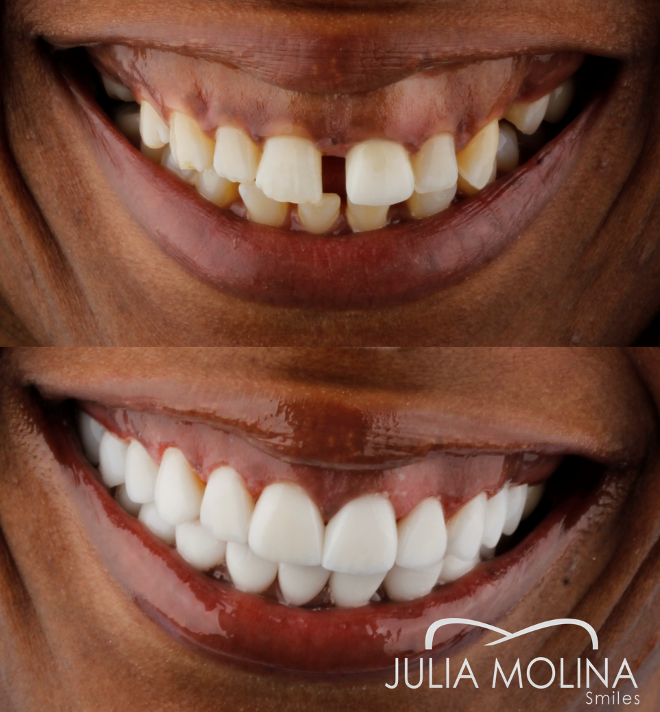 Antes y después tratamiento dental Dr Julia Molina