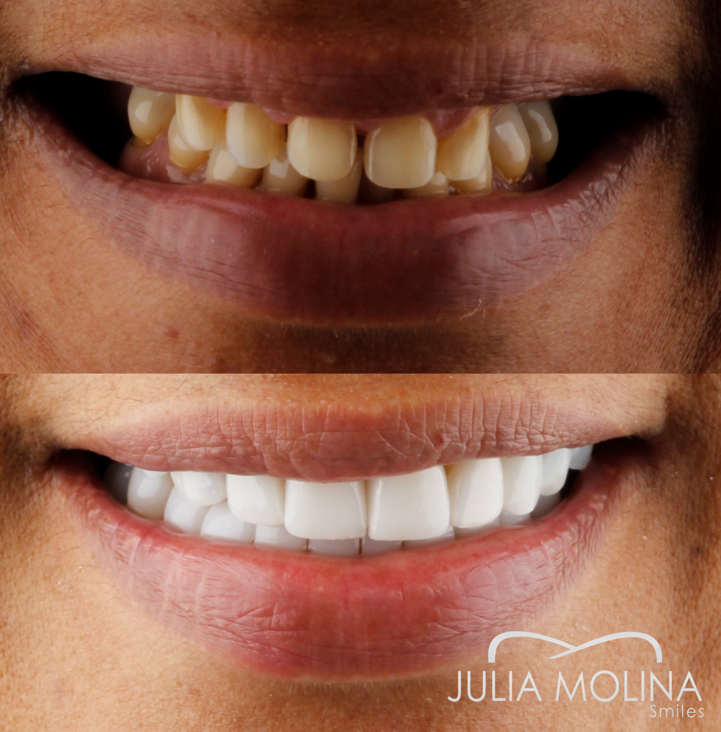 Antes y después tratamiento dental Dr Julia Molina