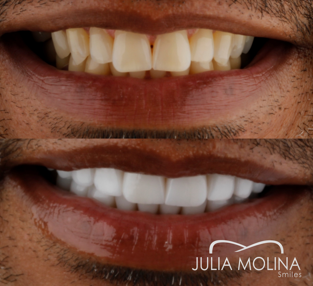 Antes y después tratamiento dental Dr Julia Molina