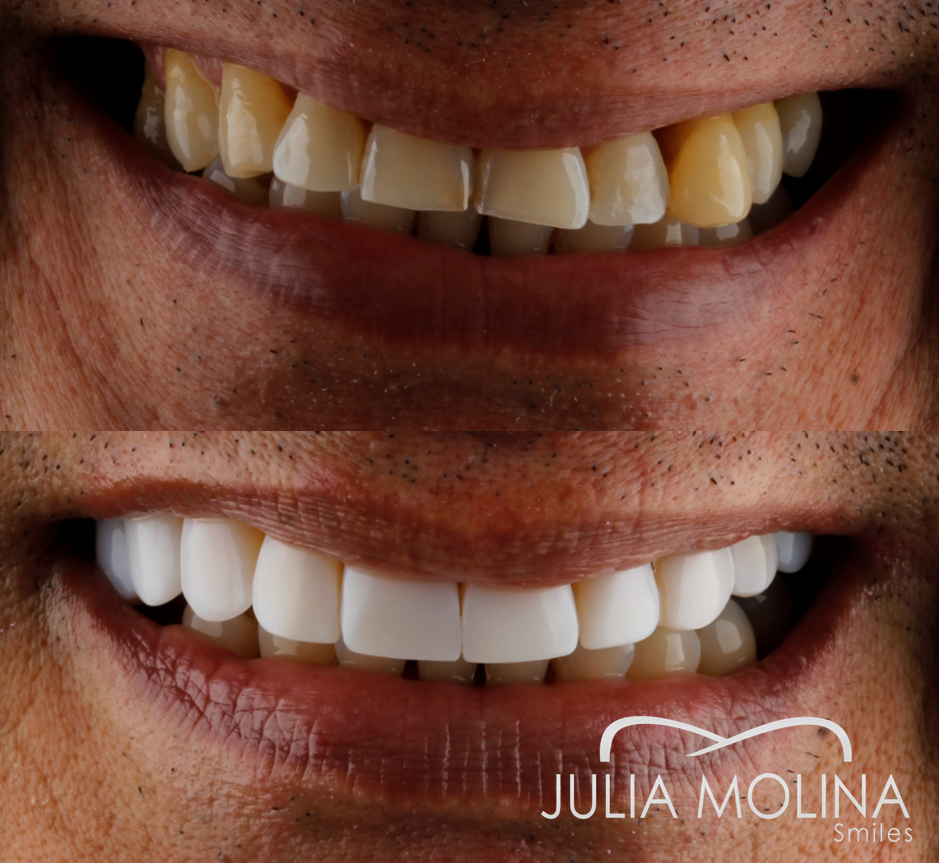Antes y después tratamiento dental Dr Julia Molina