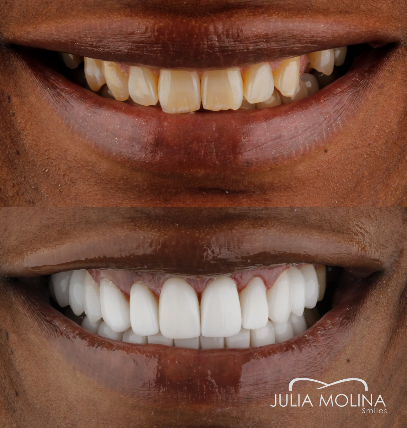 Antes y después tratamiento dental Dr Julia Molina