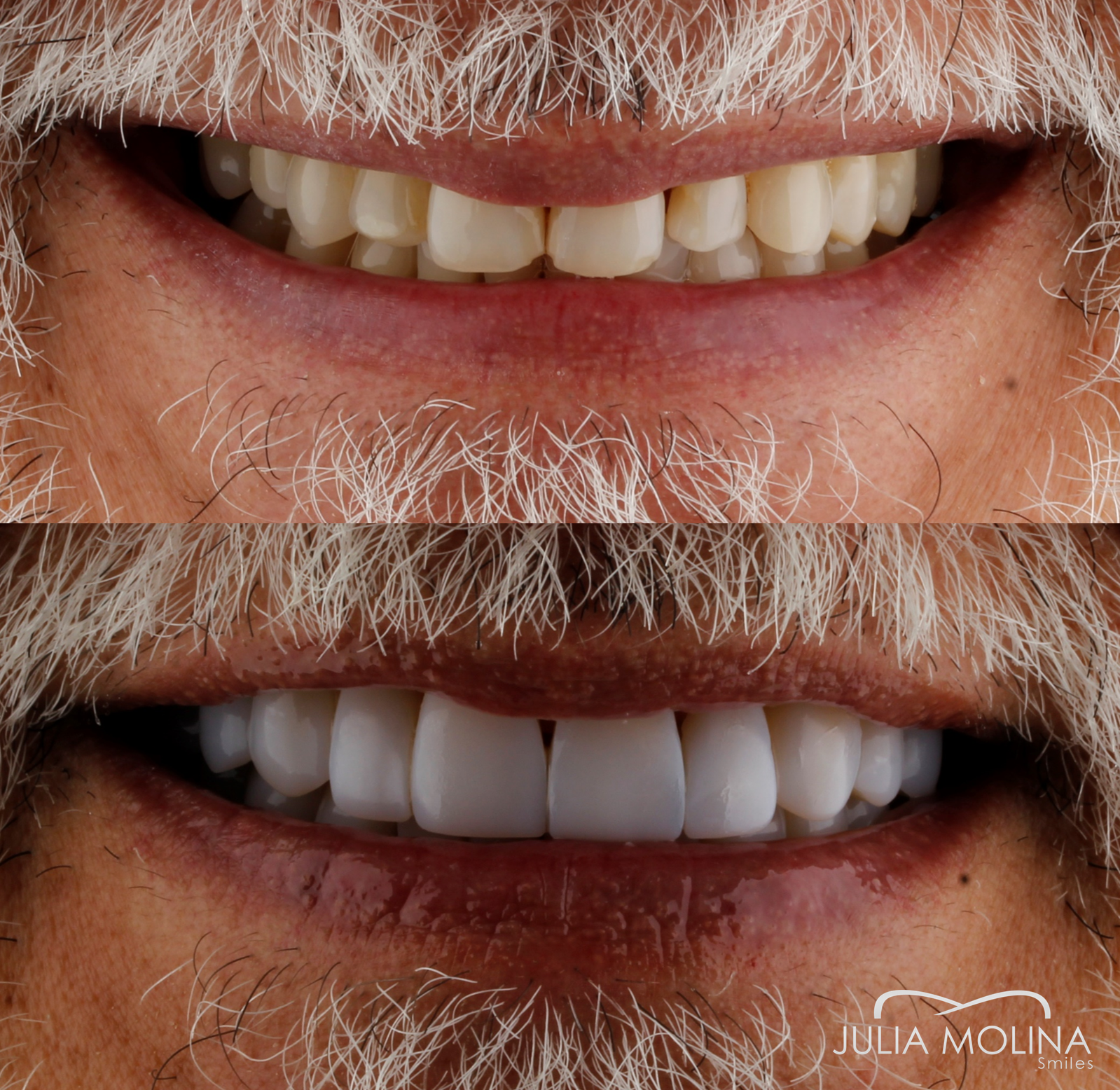 Antes y después tratamiento dental Dr Julia Molina