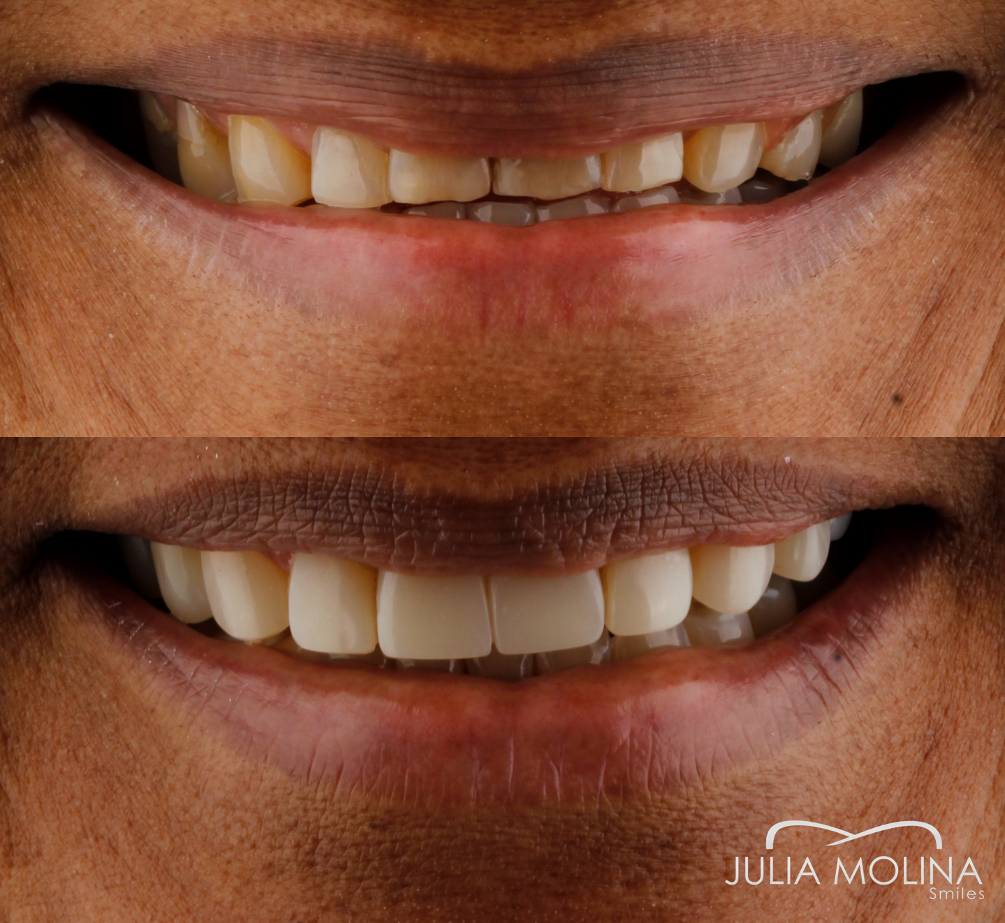 Antes y después tratamiento dental Dr Julia Molina