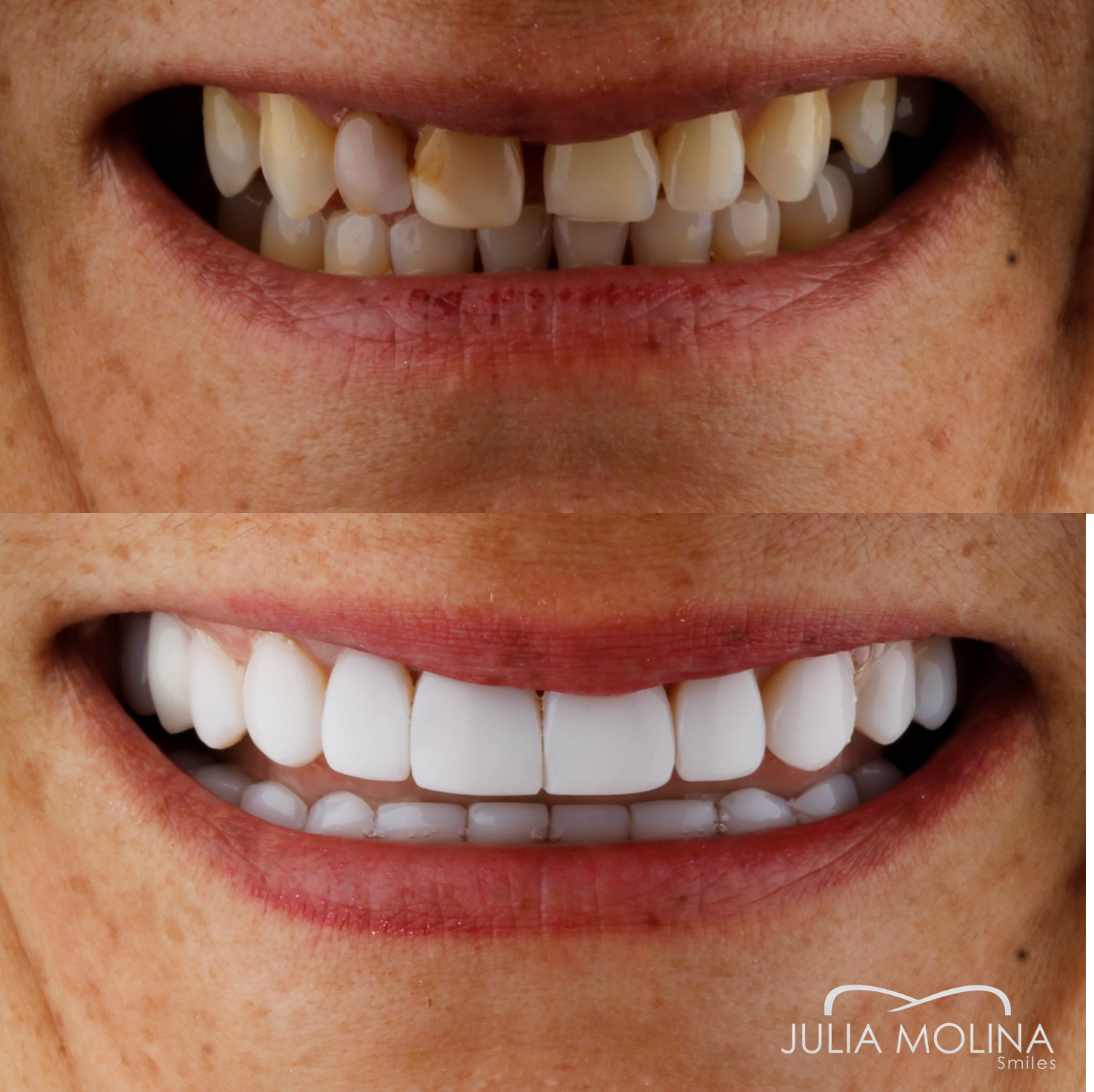 Antes y después tratamiento dental Dr Julia Molina