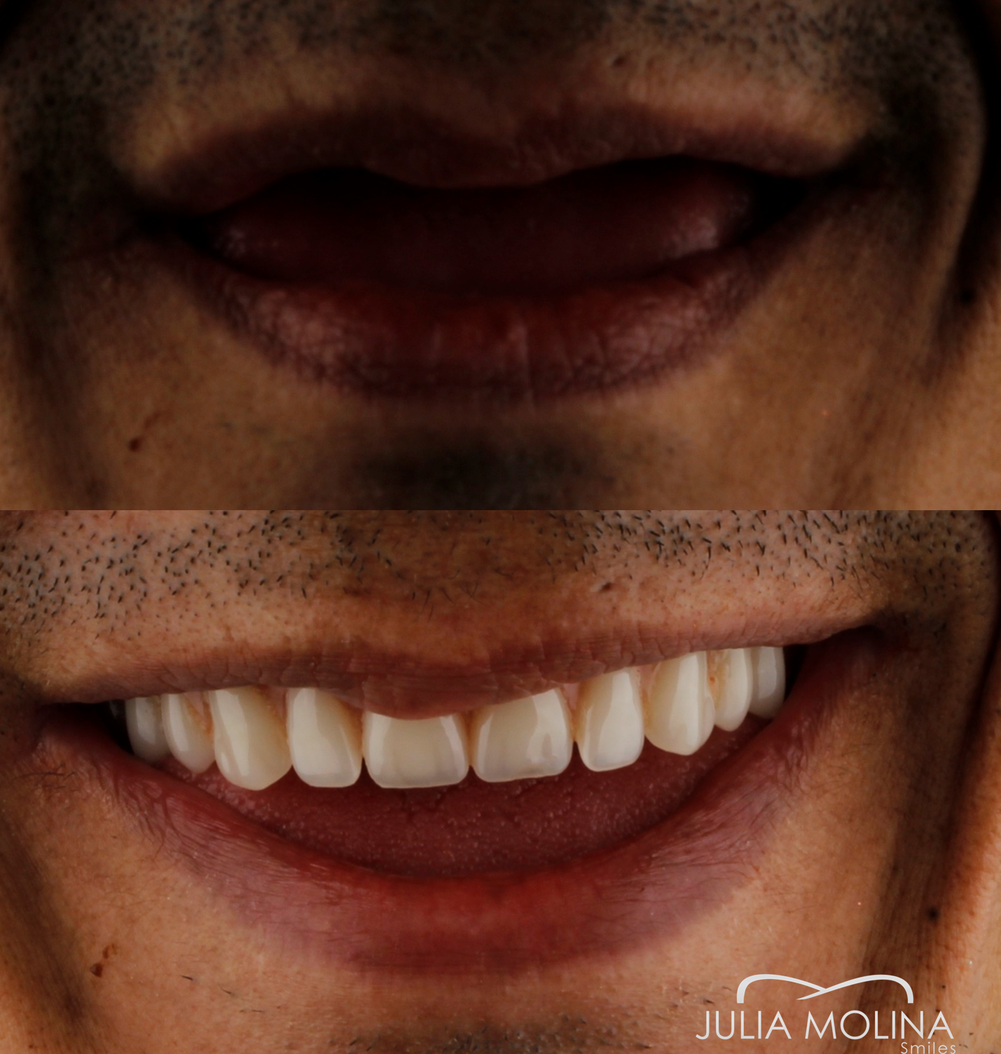 Antes y después tratamiento dental Dr Julia Molina