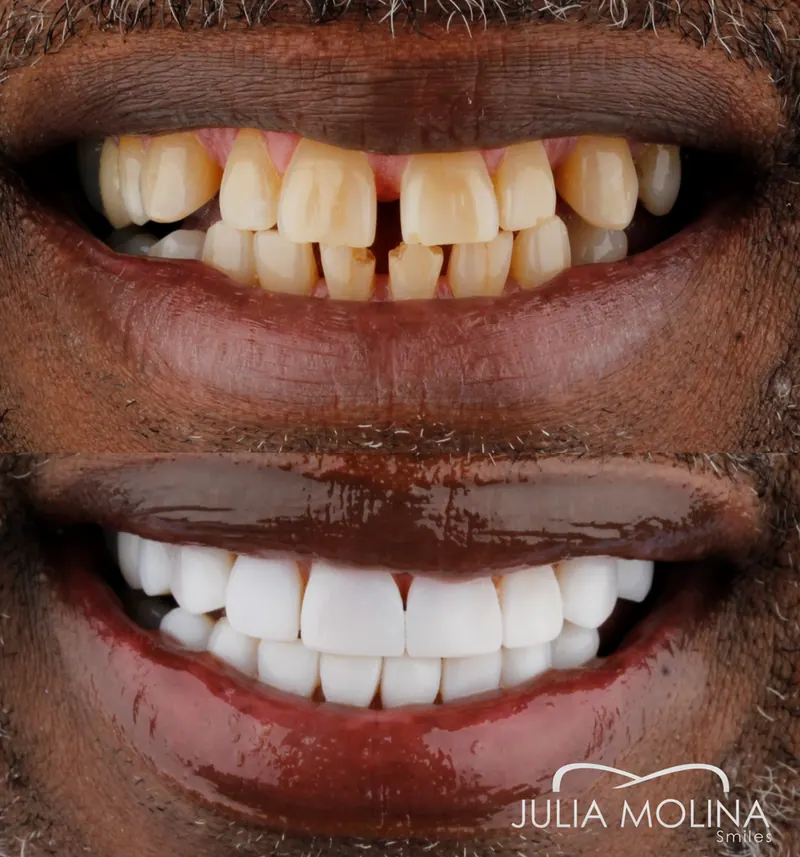 Before and after dental treatment in Colombia, case 23, Smiles by Julia Molina