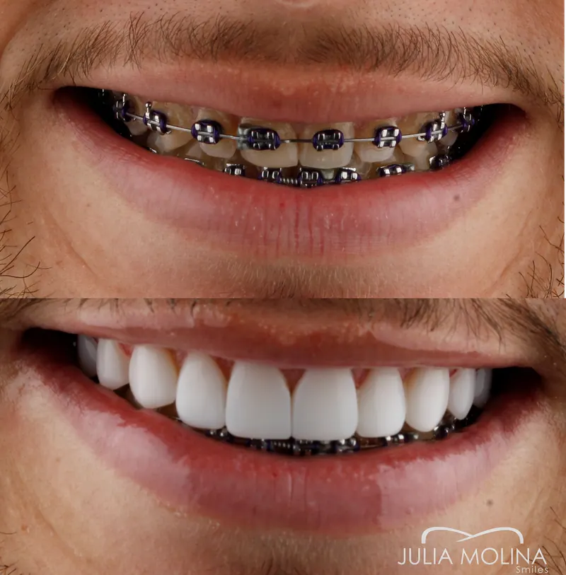Before and after dental treatment in Colombia, case 03, Smiles by Julia Molina
