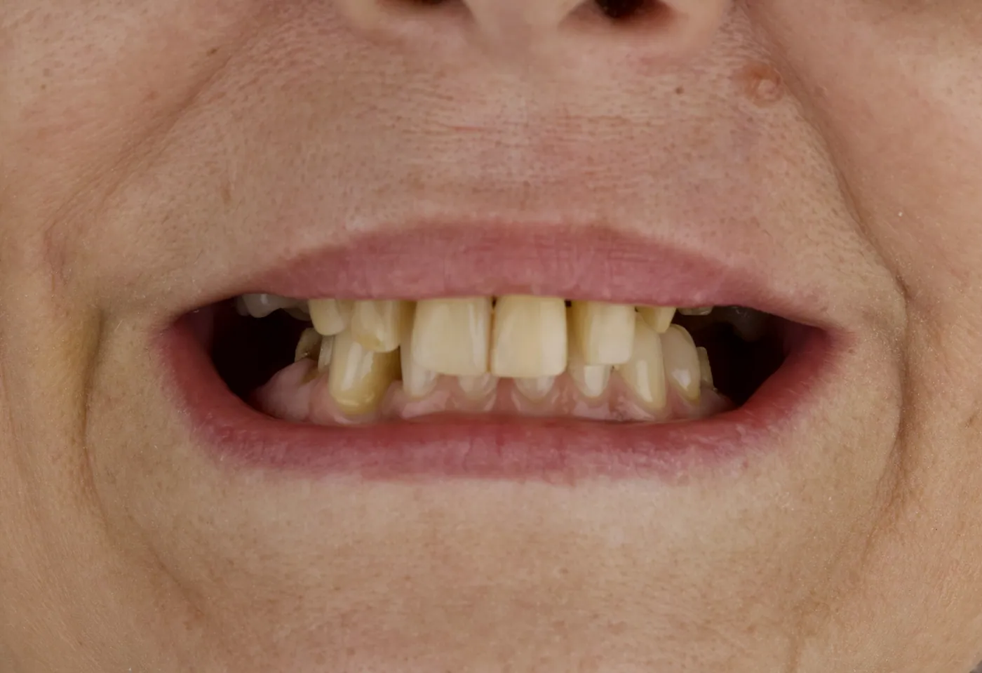 Smile before resin veneers