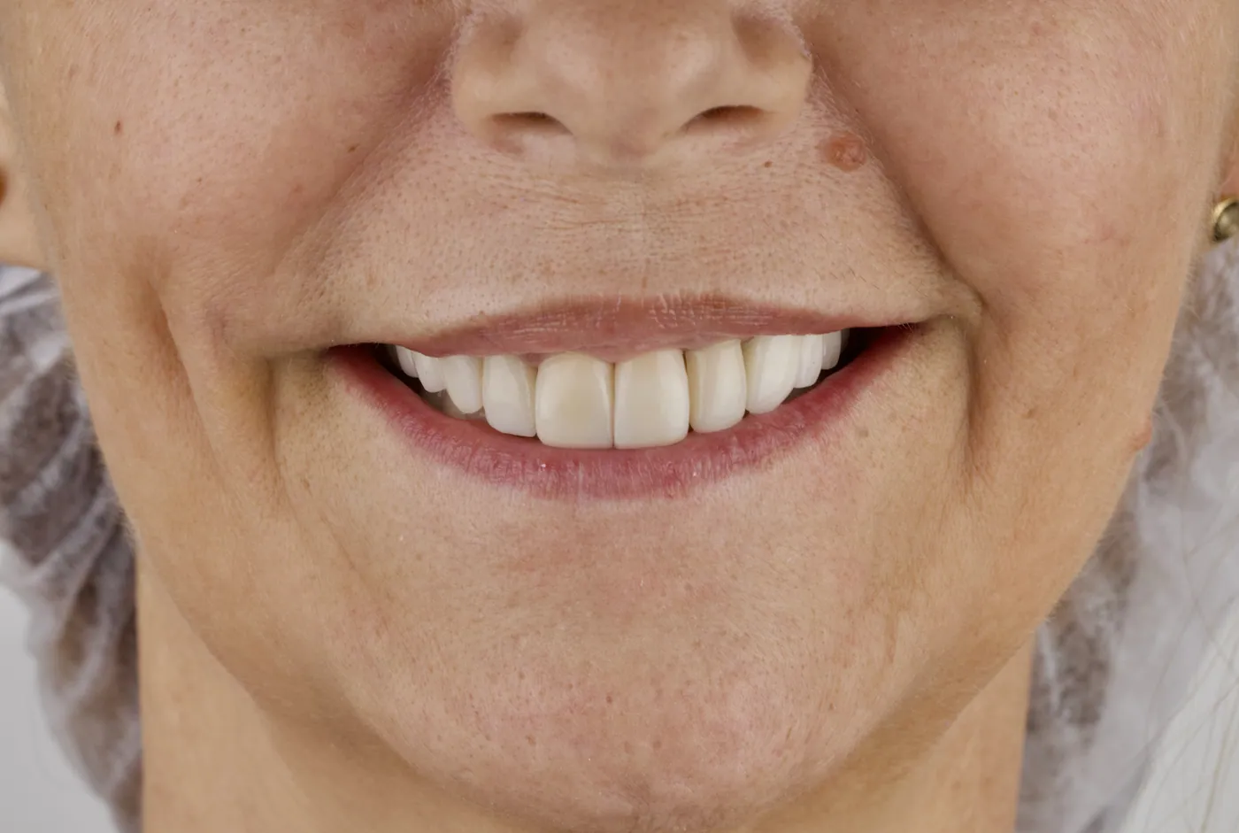 Smile after high-aesthetic resin veneers, Smiles by Julia Molina