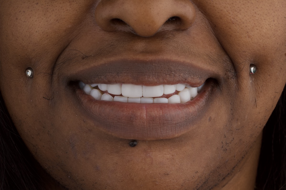 After dental treatment Colombia beautiful smile result